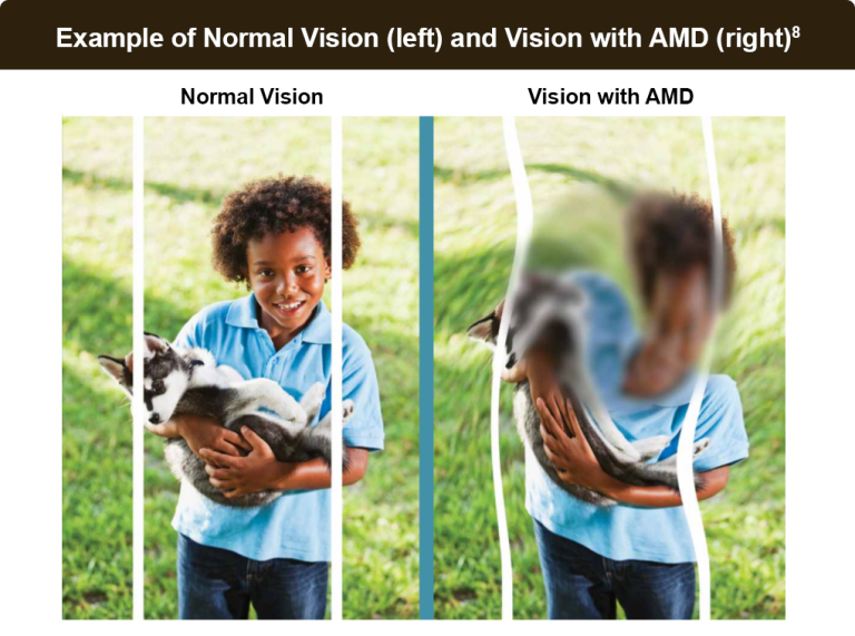 Age-Related Macular Degeneration Information: Advice: Vision RELIEF