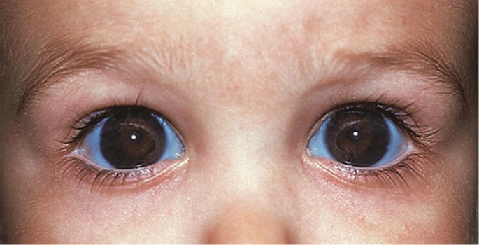 گلوکوم نوزادان - بزرگ شدن غیرطبیعی چشمها