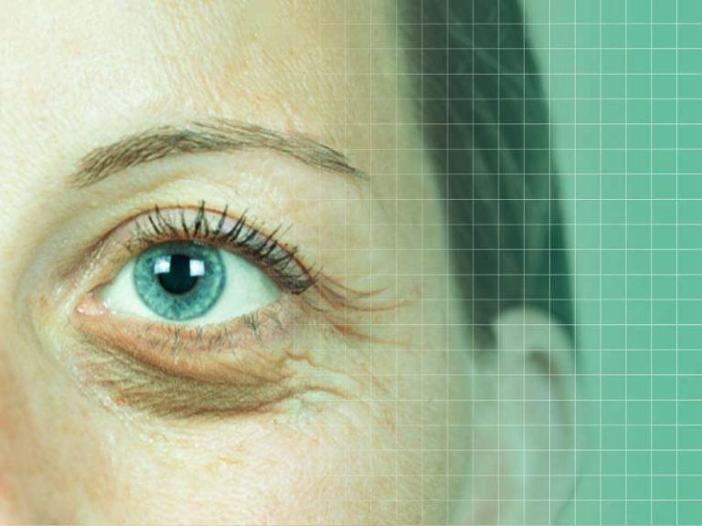 چه موقع نیاز به بلفاروپلاستی داریم؟