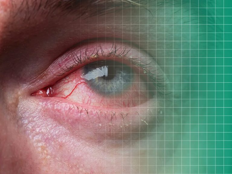 تاثیر دیابت بر بینایی | بیماری‌های چشمی مرتبط با دیابت